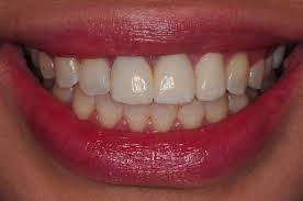 Rezultat zobnih implantatov 1